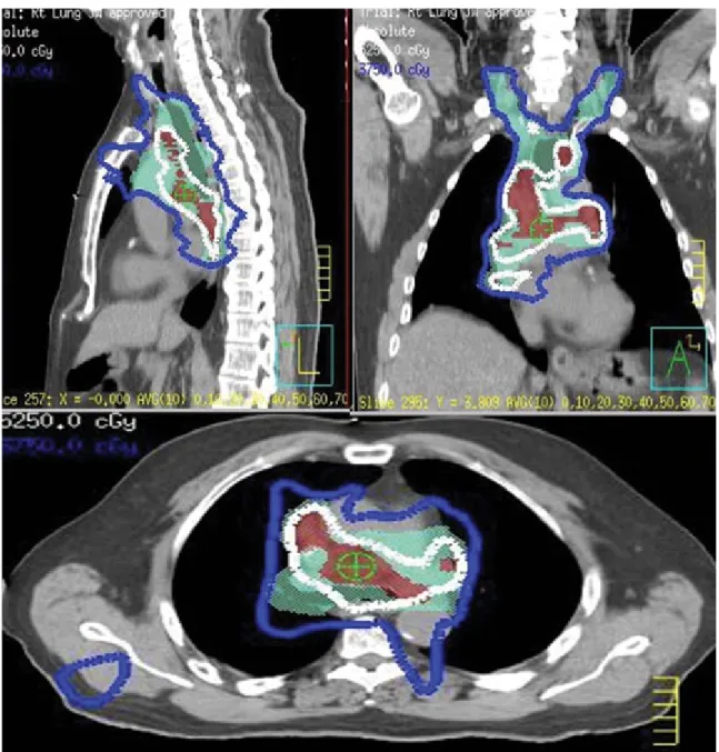 FIG. 5.  IMRT-based  simultaneous  integrated  boost  to  52.5  Gy  (3.5  Gy/fraction/day)  to  an  integrated  gross  tumor  volume,  while  keeping  the 