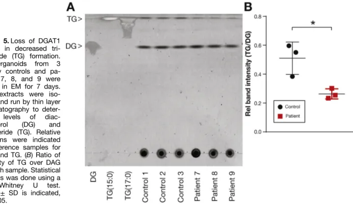 Figure 5. Loss of DGAT1 results in decreased  tri-glyceride (TG) formation. (A) Organoids from 3 healthy controls and  pa-tients 7, 8, and 9 were grown in EM for 7 days