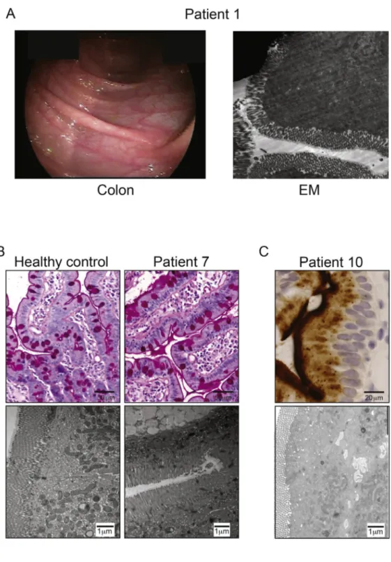 Figure 1. Histologic and endoscopic  characteris-tics of intestines of DGAT1-de ﬁcient patients
