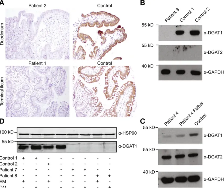Figure 2. DGAT1 protein expression in patient-derived material. (A) Immunohistochemistry of DGAT1 in control and patient 1 and patient 2 ileal and duodenal biopsy, respectively