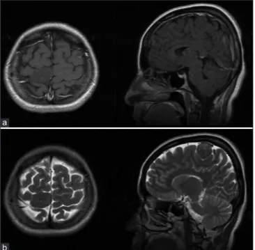 Figure 2: (a) Image of the resected tumor. (b) Light microscopy of the tumor 