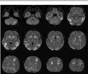 Figure 1a.  MRI  FLAIR  images  show  bilateral  multiple 