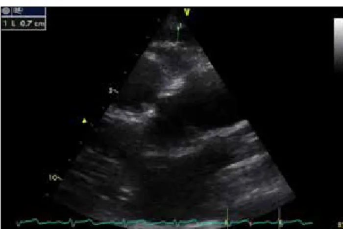 Figure 1. Measurements of epicardial fat thickness on the free wall of 