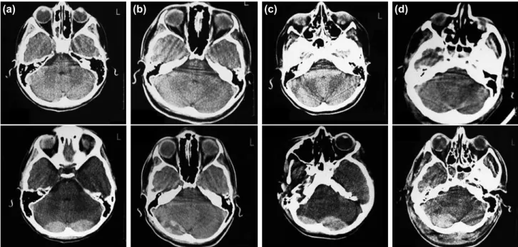Figure 1. (a) Case 1: S.K., 9 years old, initial computed tomography (CT) view (above) and view after 24 hours (below)