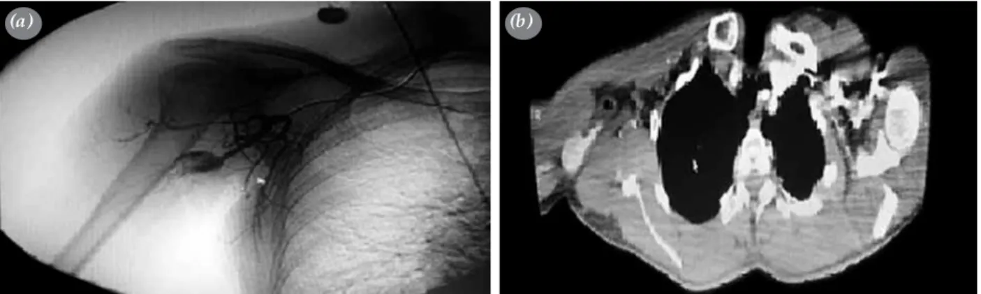 Figure 1.  (a)  Angiographic  image  of  the  axillary  artery  aneurysm.  (b)  Computed  tomography  image  of  the  axillary  artery 
