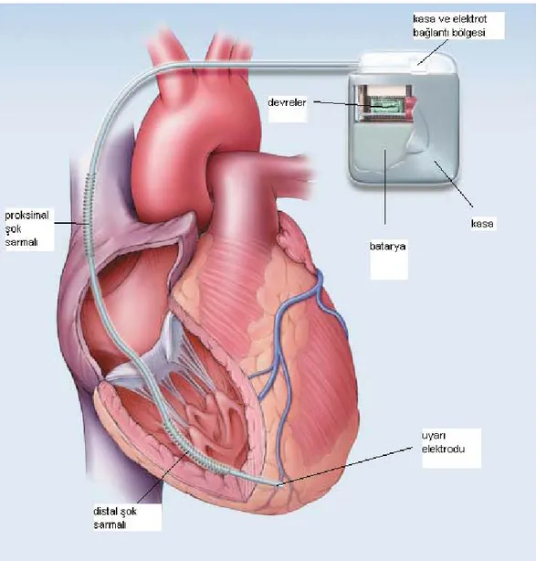 Şekil  2.2.1.  Tek  Odacıklı  Bir  İmplante  Edilebilir  Kardiyoverter-Defibrilatörün (ICD)  Şematik Gösterimi:  