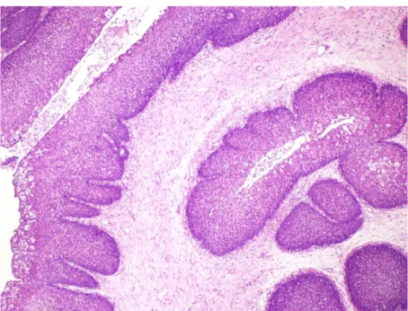 Şekil  9:  IP  histopatolojik  görüntüsü-2.  İnflamatuar  hücreler  ve  vasküler  yapılar  içeren  fibromiksoid  stromada  endofitik  gelişim  gösteren  nonkeratinize  skuamöz  epitelle döşeli adalar izlenmektedir, (H&amp;Ex40), inverted papillom