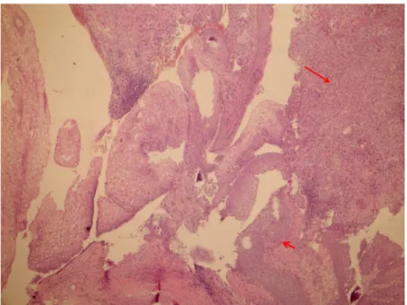 Şekil 14: SCC histopatolojik görüntüsü-2. Kordonlar, papiller yapılar oluşturan epitel  adaları (kısa ok ile işaretli alan), invaziv atipik skuamöz hücreler (uzun ok ile işaretli  alan) izlenmektedir, H.EX200, skuamoz hücreli karsinom
