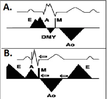 Şekil  2.1.  A.  Atriyoventriküler  (AV)  ileti  gecikmesinin  mitral  doluş  akımlarına  ve  mitral  yetersizliğine  (MY)  etkisi  görülmektedir