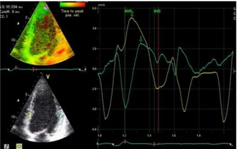 Şekil  2.4.  Kalp  siklusu  boyunca  miyokart  doku  Doppler  hızlarının  grafiksel  gösterilmesi
