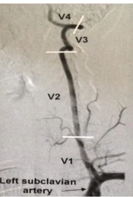 ġekil 4 :  Vertebral Arter