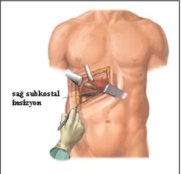 Şekil 2.3. Açık kolesistektomi(23)  