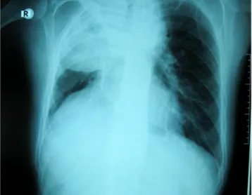 Figure 1. Thoracic CT shows that the cancer tissue led to narro-