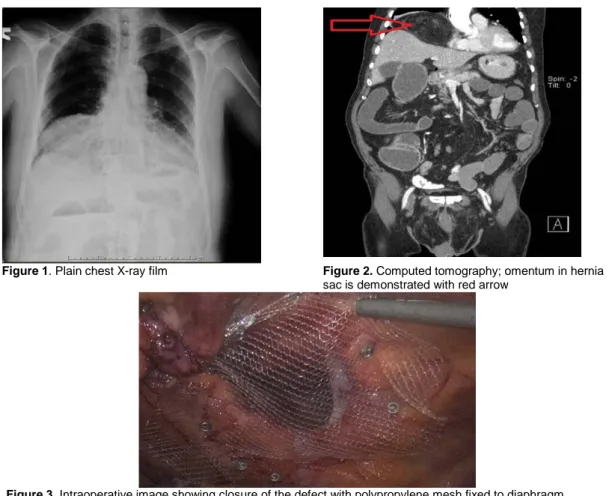 Figure 1. Plain chest X-ray film  Figure 2. Computed tomography; omentum in hernia 