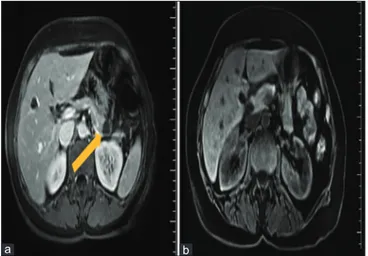 Figure 1: (a) Magnetic resonance imaging at the level of the upper abdomen  shows a solitary cystic mass with septations in the region of the pancreatic  tail