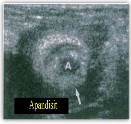 Şekil 2.4 Akut apandisitin Ultrasonografi görüntüsü; apandiks duvarında kalınlaşma(ok ile 