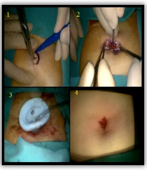 Şekil 2.9 Tek insizyon laparoskopik apendektomi; 1) Göbek insizyonu 2) Fasya açılırken 