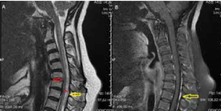 Figure 2. T2 weighted spin echo sequence (A) and postcontrast fat saturated T1  weighted spin echo sequence(B) in flexion