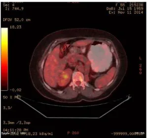 Figure 1. Nodularity demonstrating contrast uptake  at the level of the pancreatic head during the arterial  phase of the abdominal CT 