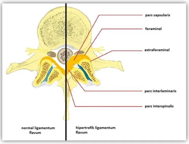 Şekil 8. Ligamentum flavum aksiyel plandaki parçaları 