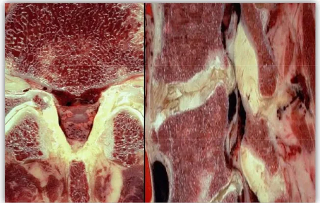 Şekil 12. Ligamentum flavum hipertrofisinin kadavra üzerinde aksiyel ve sagital görüntüleri 