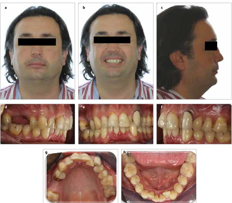 Figure 1. a-h. Pretreatment (T0) extraoral and intraoral images: Pretreatment extraoral frontal rest image (a); pretreatment extraoral frontal 