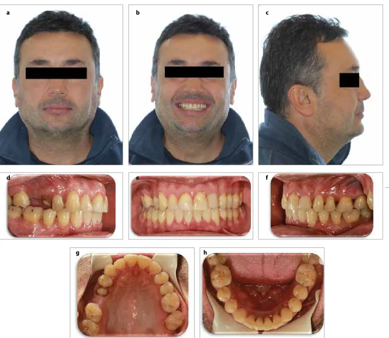 Figure 4. a-h. Post-treatment (T1) extraoral and intraoral images: Post-treatment extraoral frontal rest image (a); post-treatment extraoral frontal smile 