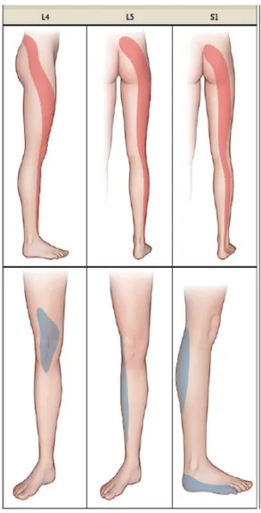 Şekil 2.8. Herniasyon seviyelerine göre ağrı ve  duyu bozuklukları bölgeleri (10). 