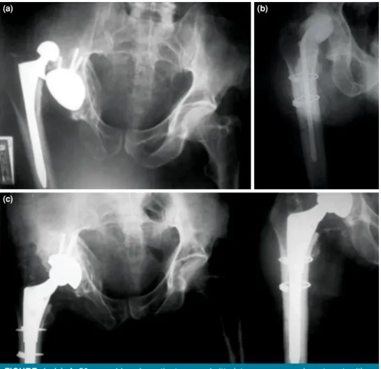 FIGURE 1.  (a) A 50-year-old male patient was admitted to emergency department with a 