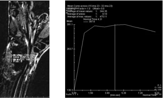 Figure 4. Subtracted images at  early arterial phase showed  peripheral enhancement pattern  of the mass