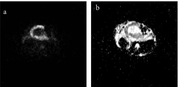 Figure 8. (H&amp;E, X200) grade 3 chondrosarcoma  characterized by atypical pleomorphic mesenchymal  cells with prominent nucleolus 