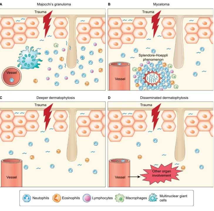 Figure 1 Pathogenesis of invasive dermatophytosis. 