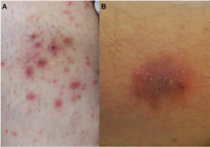 Figure 2 Multiple erythematous papules and nodules with scales and/or crusts 