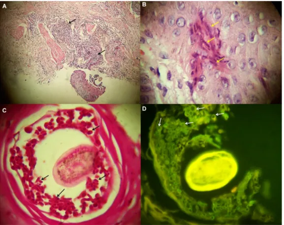 Figure 4 Histopathological findings of a patient with MG. 