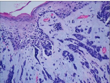 Figure 3: Nipple epidermis containing Paget cells with pale- pale-stained cytoplasm and irregular nuclei (H&amp;E; x200).