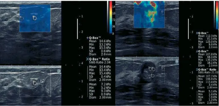 Şekil  4.  Shear  wave  elastografi  yöntemi  ile  benign  (fibroadenom)  ve  malign  (kolloid  kanser) 
