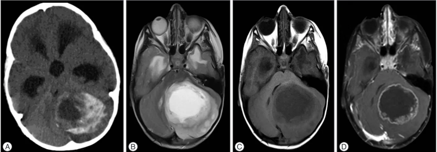 Fig. 1. Preoperative radiological findings. A : Preoperative CT demonstrated cystic, peripheral enhancing calcified lesion