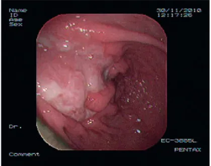 Figure 1 - Colonoscopy: shaped ulceration 