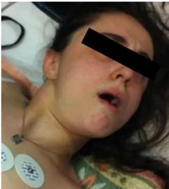 Figure 2: The view of torticollis and trismus 