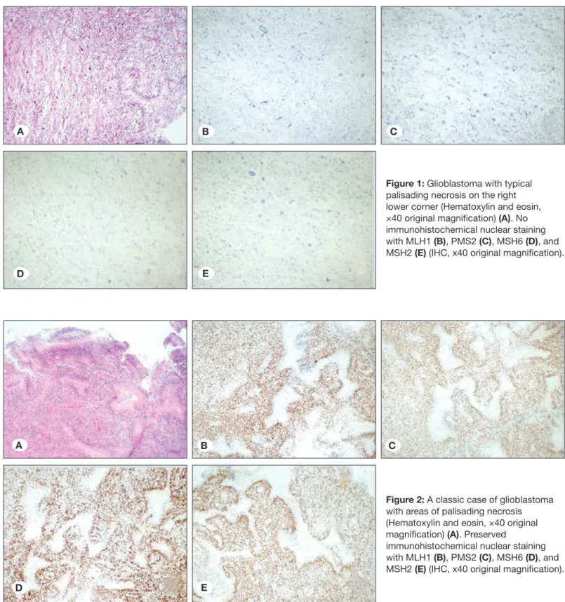 Figure 1: Glioblastoma with typical  palisading necrosis on the right  lower corner (Hematoxylin and eosin,  ×40 original magnification) (A)