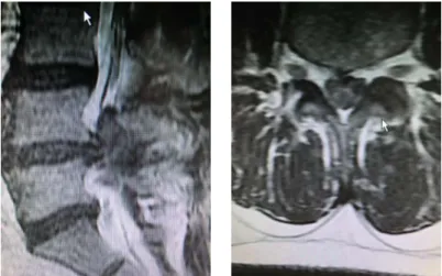 Şekil 1E. Epidural alana göç etmiş disk parçası. 