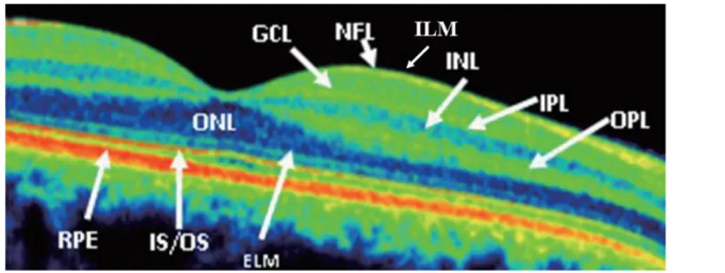 Şekil  2.1’de  sağlıklı  bireylerde  retina  katmanlarının  optik  koherens  tomografi  bulguları  gösterilmiştir