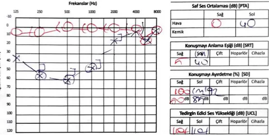ġekil  3.1.  Hidrops  bulguları  olan  bir  hastanın  alçak  frekans  işitme  kaybının  görüldüğü  odyolojik değerlendirme sonucu