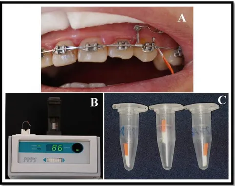 Şekil 3.4. Diş eti oluğu sıvısı (DOS) örneklerinin alınması, A. Sol kanin dişin diş eti cebinin 