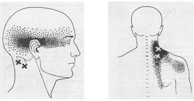 Şekil 3.6 Suboccipital kaslar ile Levator Scapula kaslardaki tetik noktalar 