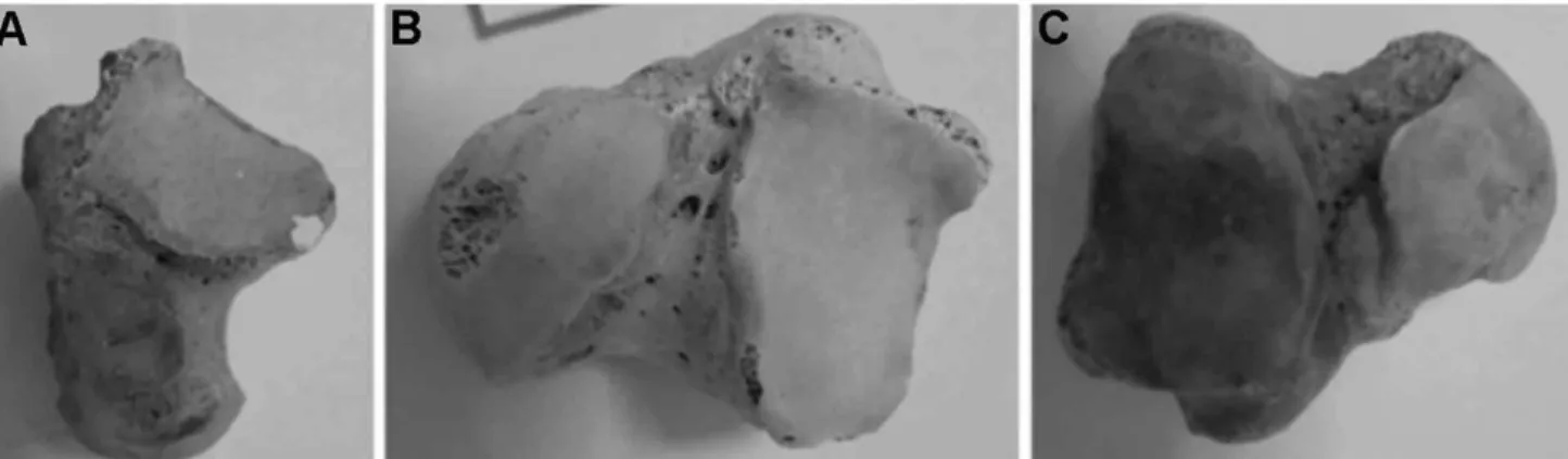 Fig. 2. Articular facet types of calcaneus: A. Type A1; B. Type A2; C. Type A3; D. Type A4; E