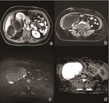 Figure  1: (a)  Axial  contrast-enhanced  T1-weighted  magnetic  resonance image shows a cyst into retroperitoneal cyst containing thin septations, and noduler, papillary projections