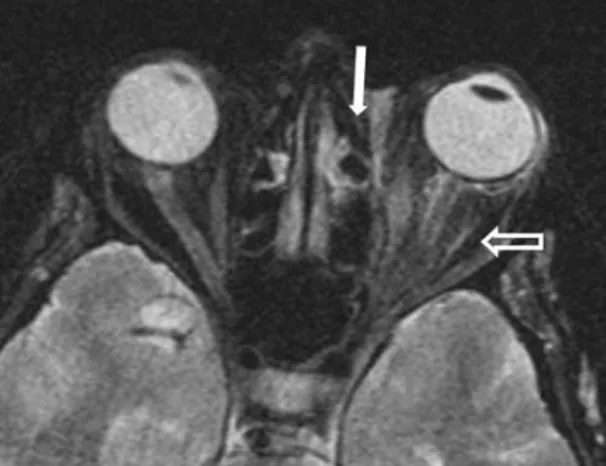 Figure 2. On orbital MRI; mild proptotic appearance in the left globe, linear signal increment around the optic nerve and 