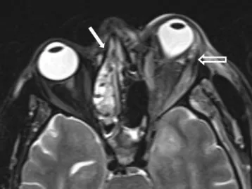 Figure 3.  On control MRI; notable worsening in the left exophthalmos, increase in the anteroposterior size of the left 