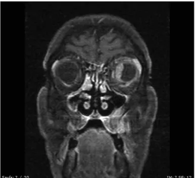 Figure 2. Mass lesion having sellar–suprasellar localization, generating 